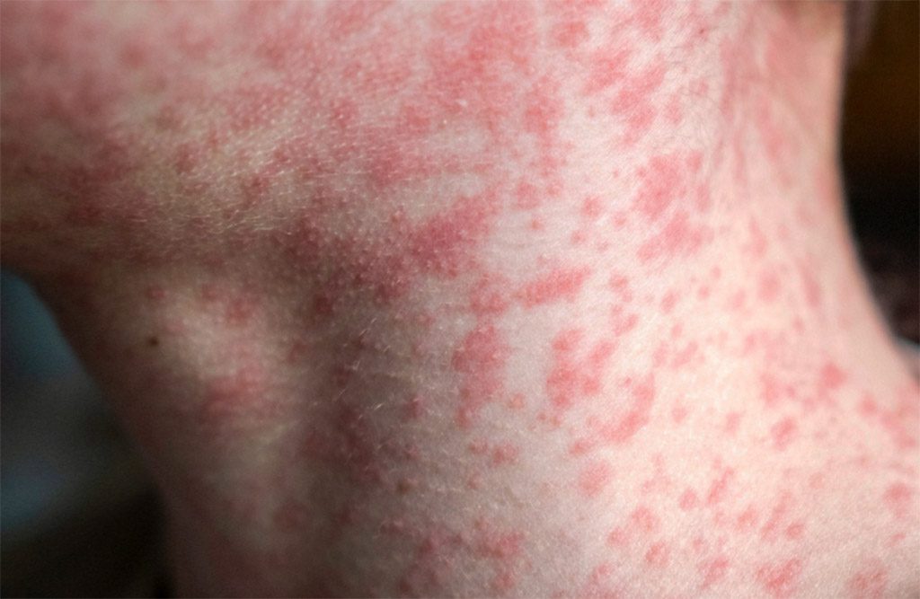 Brote de sarampión supera 12 mil contagios confirmados en México